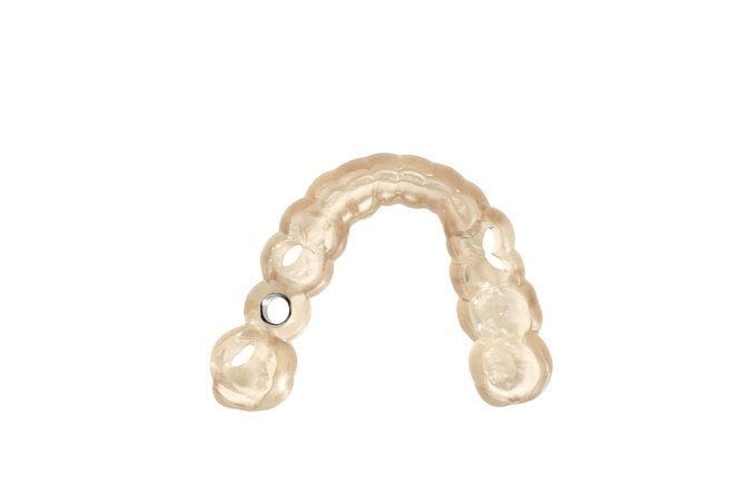 Clear printed dental surgical guide with a metal drill sleeve