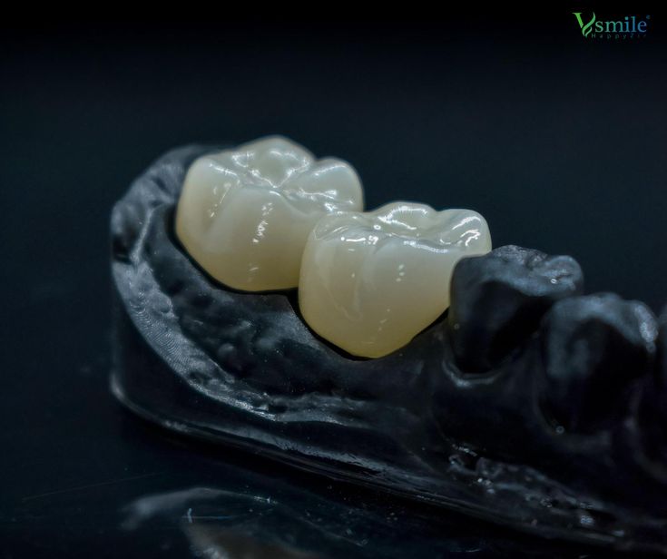 Two-unit ceramic bridge seated on a dental model