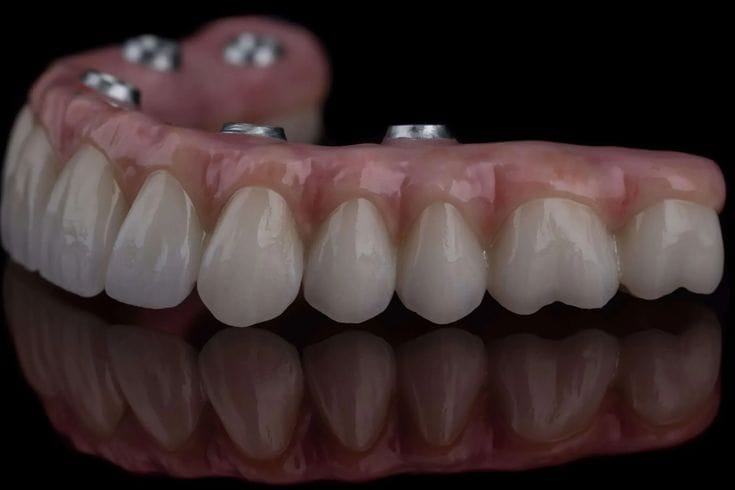 Implant-supported full-arch prosthesis with titanium abutments